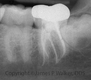 Complex Molar Anatomy